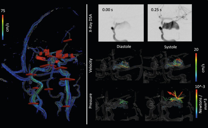 Image for Flow and Hemodynamic Alteration in a Giant Cerebral Aneurysm Treated with a Pipeline Stent