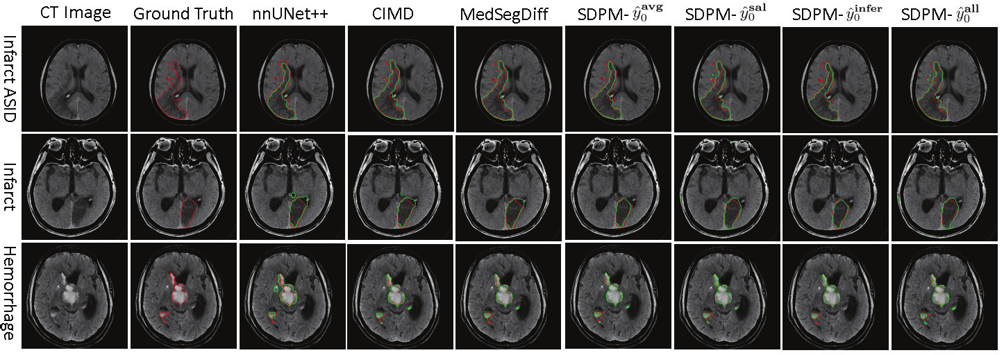Image for Synchronous Image-Label Diffusion Probability Model with Application to Stroke Lesion Segmentation on Non-contrast CT
